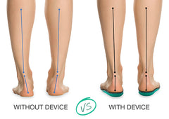 Anti-Supination Device